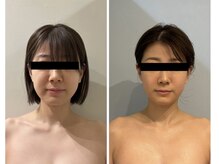 ルナグランデ 心斎橋店(Luna grande.)の雰囲気（【5ml×ボトサマ】小顔人気No.1メニュー）