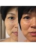 老け見え解消／しわたるみ・リフトアップインディバフェイシャル120分24000→