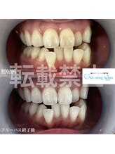 ホワイトニングサロン 熊本店/人気ホワイトニング
