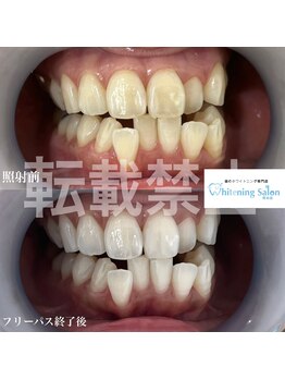 ホワイトニングサロン 熊本店/人気ホワイトニング