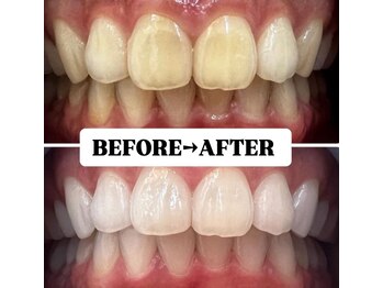 ホワイトニングサロン 豊中/Before&After美白ホワイトニング