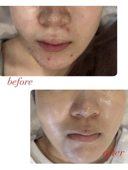 メゾン カルム 天文館店(MAISON CALME)/肌質改善