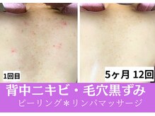 おうちサロン ミキ/背中ニキビ/ポツポツ毛穴/黒ずみ