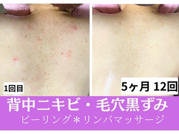 おうちサロン ミキ/背中ニキビ/ポツポツ毛穴/黒ずみ