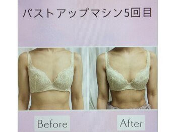 サロン アイミー(salon i me)/バストアップ症例