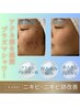 【肌質改善】赤み肌改善プラズマシャワー+エクソソーム導入初回限定¥4980