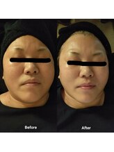 プチサロン ラナ(LANA)/フェイスWAX脱毛