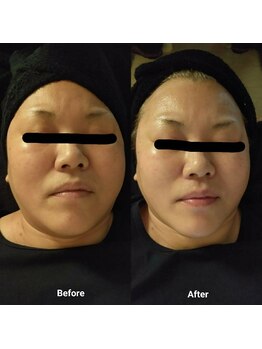 プチサロン ラナ(LANA)/フェイスWAX脱毛