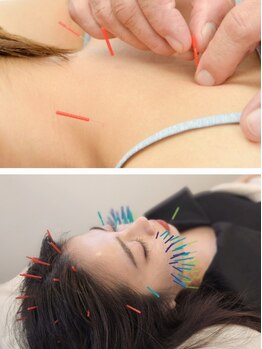 モーイ(mooi)の写真/お肌の内側・外側の両面からアプローチする「美容鍼」肌本来が持つ回復機能を活性化◎エイジングケアにも☆