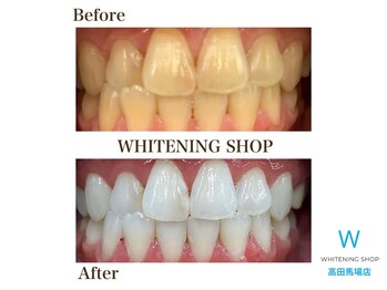 ホワイトニングショップ 高田馬場店/ホワイトニングビフォーアフター
