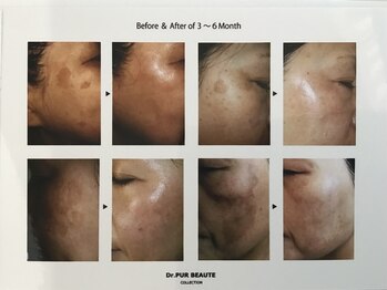 ピュール(pure)/純粋レチノールピールの効果