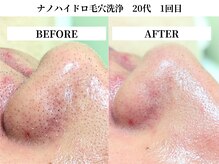 サンビ(SANBI)/頑固な黒ずみ・皮脂詰まりにも◎