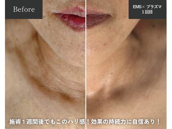 メロー(MELLOW)/プラズマスター