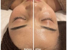 サロンアルーナ(Salon a Luna)/剥離しないハーブピーリング