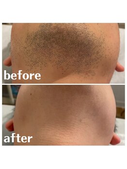 ベイス(BASE)/ヒゲ脱毛BeforeAfter