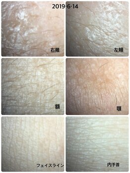 パシュ/スコープでお肌のキメをチェック