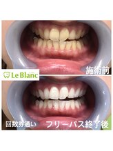 ルブラン 奈良店(Le Blanc)/最低保証回数後！！