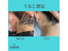 アクト クロ(ACT curro)/【うなじ襟足】脱毛施術例