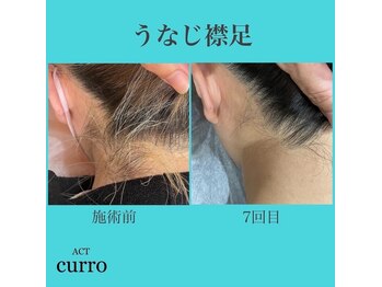 アクト クロ(ACT curro)/【うなじ襟足】脱毛施術例