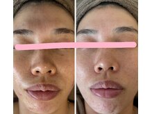 ミエル(miel)/【ハーブピーリング】ニキビケア