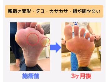 戸田はりきゅう整骨院/足指整体Before・After