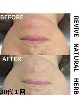 サロンドベル(salon de Belle)/ハーブピーリング/毛穴/ニキビ