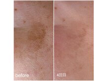 ニューリー(Newly.)の雰囲気（エリア希少！焼かないシミケア♪痛みも少なく肌質改善効果も♪）