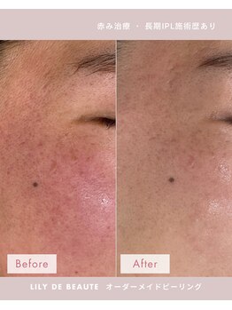 リリードボーテ 高槻店(LILY DE BEAUTE)/赤ら顔Before/After