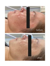 ココハリ/酒さのお客様