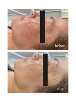 ココハリ/酒さのお客様