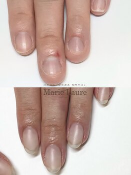 マリーロール 梅田店(Marie Laure)/自爪育成/深爪矯正/ネイルケア