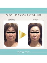 ニュウミー 諏訪本店(newme)/小顔　ビフォーアフター8