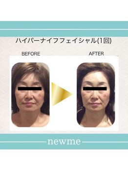 ニュウミー 諏訪本店(newme)/小顔　ビフォーアフター8