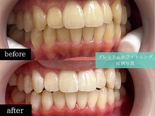 ホワイトニングカフェ 博多駅前店(WhiteningCafe)/◎歯のホワイトニング施術写真◎