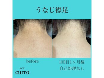 アクト クロ(ACT curro)/【うなじ襟足】脱毛施術例