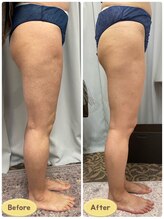 FJ/セル脂肪改善