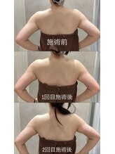 ピリナ(Pilina)/背中、二の腕スッキリコース