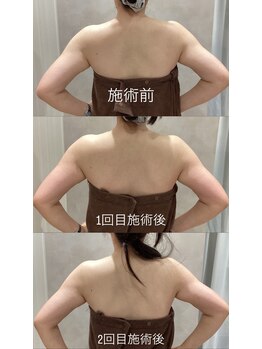 ピリナ(Pilina)/背中、二の腕スッキリコース