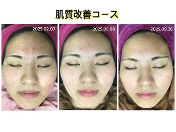 ソレイユ/肌質改善コース