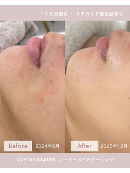 リリードボーテ 高槻店(LILY DE BEAUTE)/ザラつき・肌荒れBefore/After