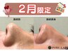 【2月限定】いちご鼻解消！毛穴洗浄＋美容液導入(ヒト幹細胞培養液)￥4980