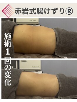 リア(Lia)/40代女性施術1回の効果