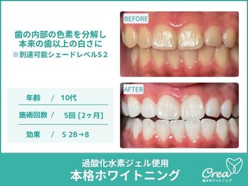 クレア(Crea)/【ホワイトニング症例写真】