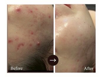ヴェルデ 池袋西口店(Verde)の写真/マシンにこだわるエステ!プラズマ肌育ケアでニキビ・毛穴・くすみを徹底改善◎透明感あふれる水光美肌へ♪