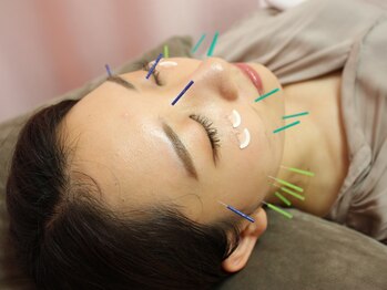 同心整体院の写真/筋肉を刺激し根本からアプローチ《美肌美容鍼30分¥3000～》むくみ改善　《小顔耳つぼジュエリー¥3000～》
