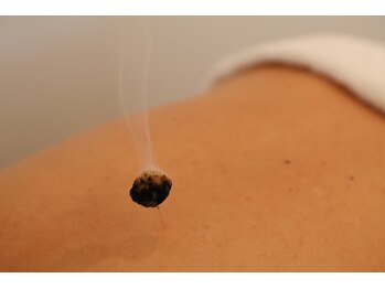 銀座マロニエ通り治療院/【特別鍼灸】灸頭鍼-鍼とお灸