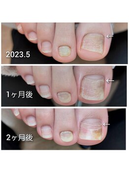 爪の成長　その３