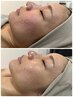 【皮膚科提携】毛穴,跡ニキビケア｜水光ピーリング(毛穴洗浄付)＋ヘッドスパ