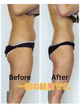 レン(ReN)/３０代　痩身お試し