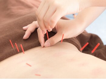 堺整骨院 JR久留米院 の写真/鍼＋電気で、長年の痛みにダイレクト効果も！